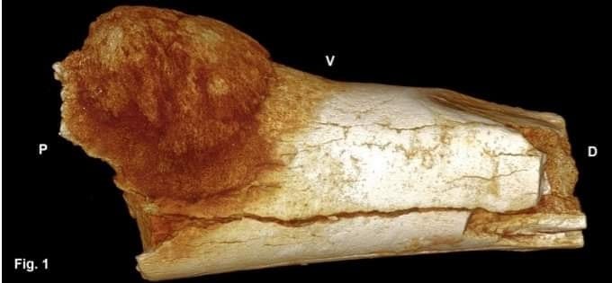 Fossil evidence of ancient bone cancer