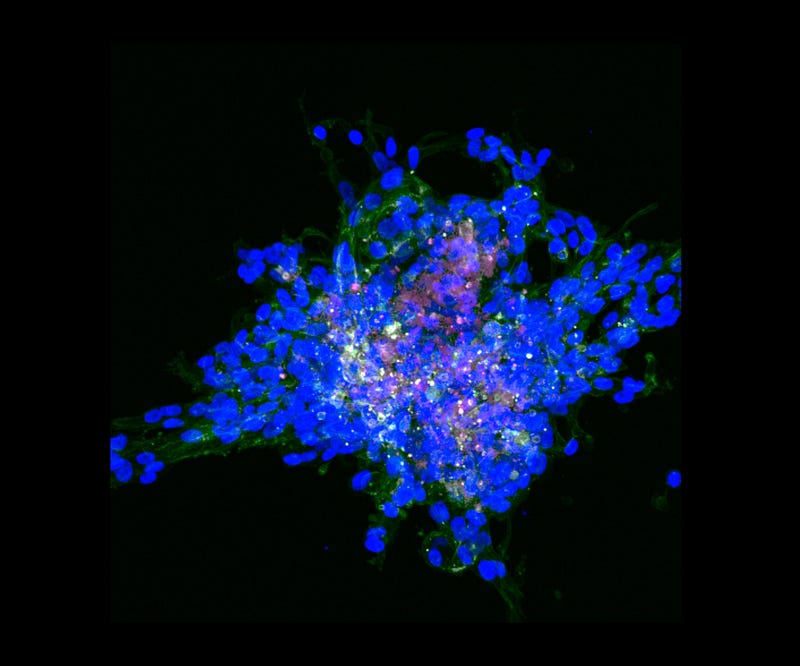 Fluorescent blue cells demonstrating cancer cell disorganization